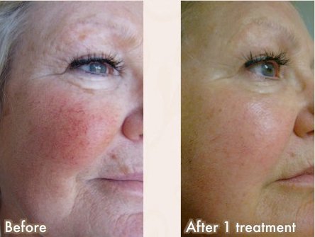 How does IPL work for Pigmentation?
